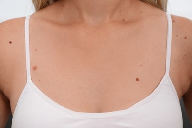 Photo of Closeup view of woman's body with birthmarks on white background