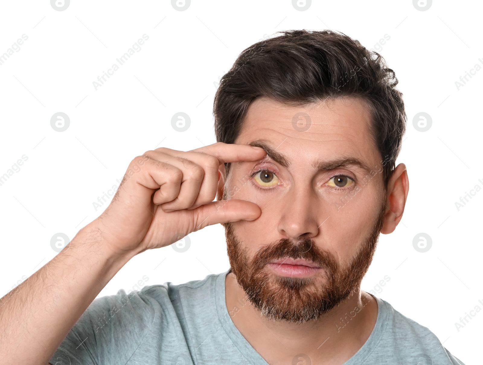 Photo of Man with yellow eyes on white background. Symptom of hepatitis