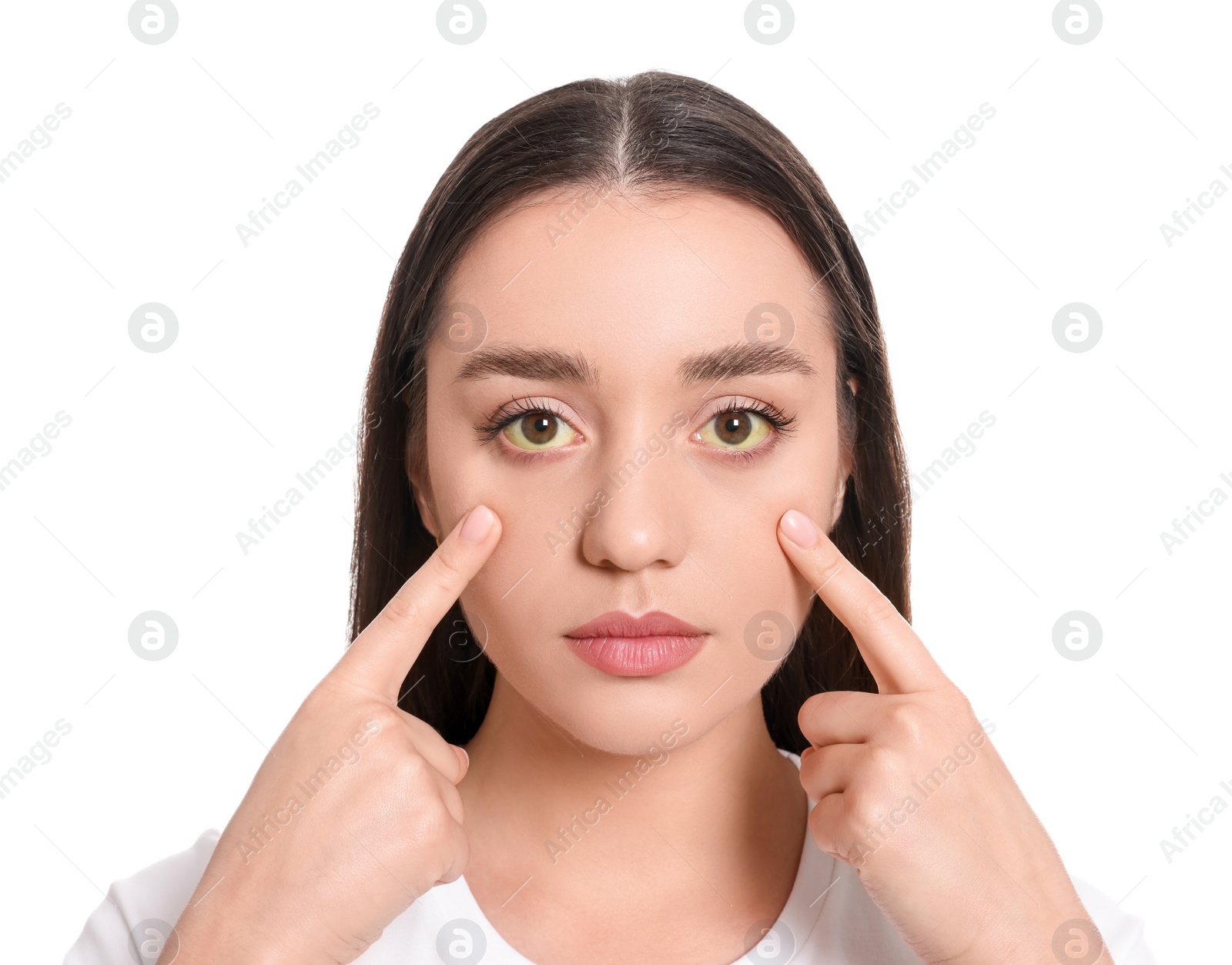 Photo of Woman with yellow eyes on white background. Symptom of hepatitis