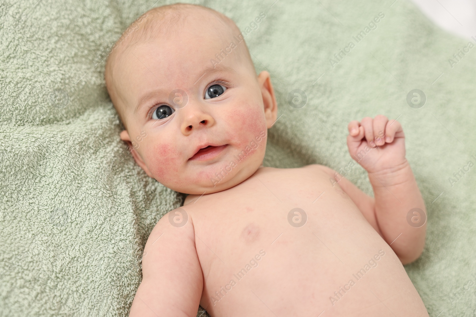 Photo of Cute little baby with allergic redness on cheeks lying on light green blanket