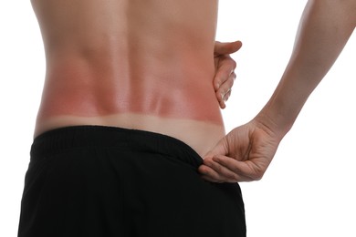 Man with sunburned skin on white background, closeup