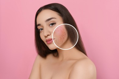 Woman with acne on her face on pink background. Zoomed area showing problem skin