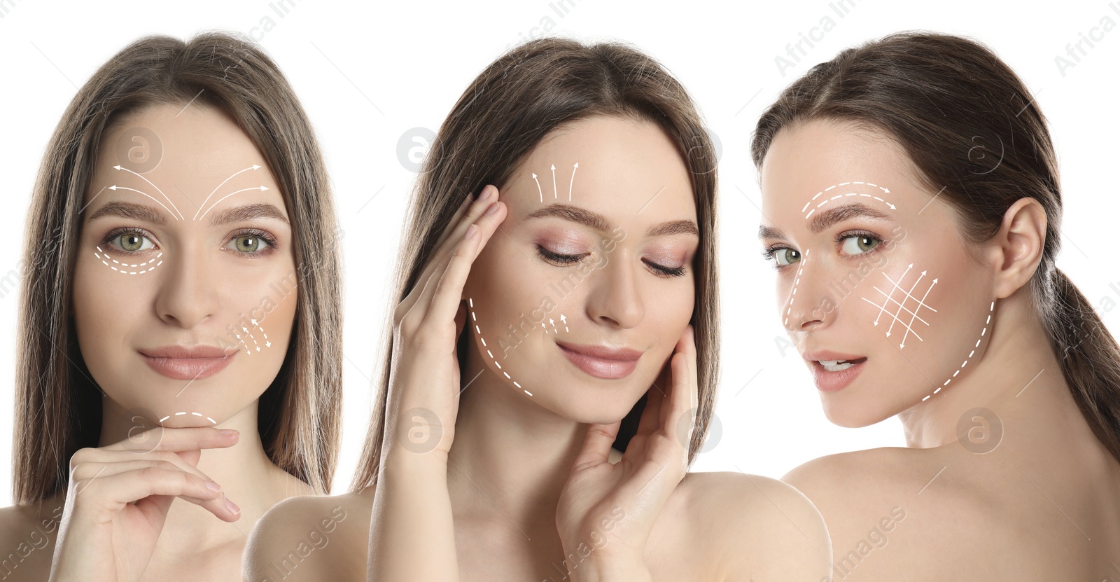 Image of Photos of young woman with lifting marks on face against white background, collage. Cosmetic surgery