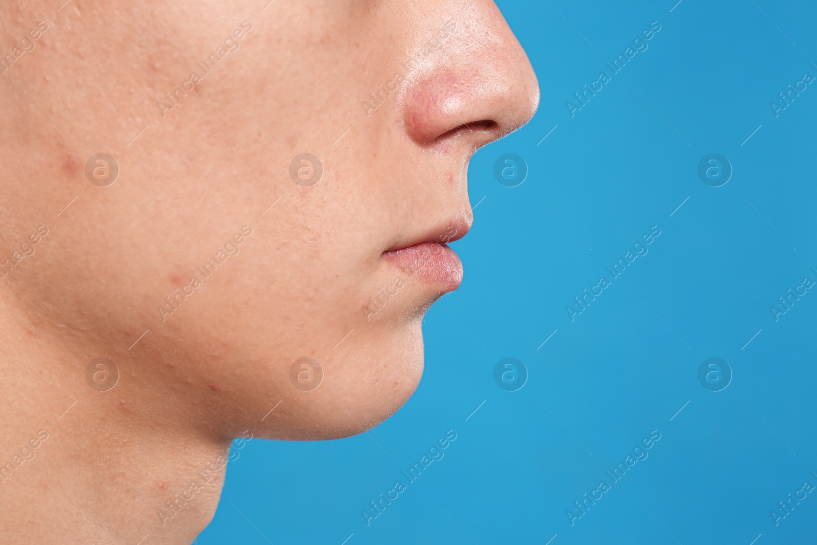 Photo of Teen guy with acne problem on blue background, closeup