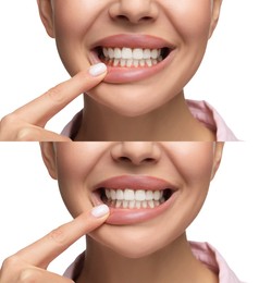 Woman showing gum before and after treatment on white background, collage of photos