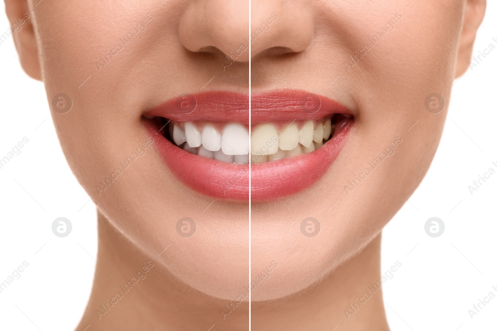 Image of Woman showing teeth before and after whitening on white background, collage