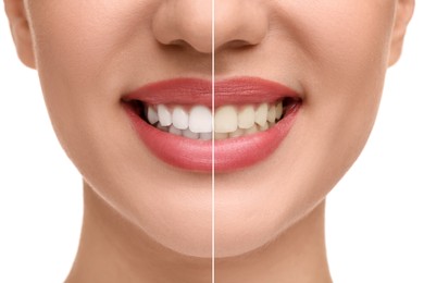 Woman showing teeth before and after whitening on white background, collage