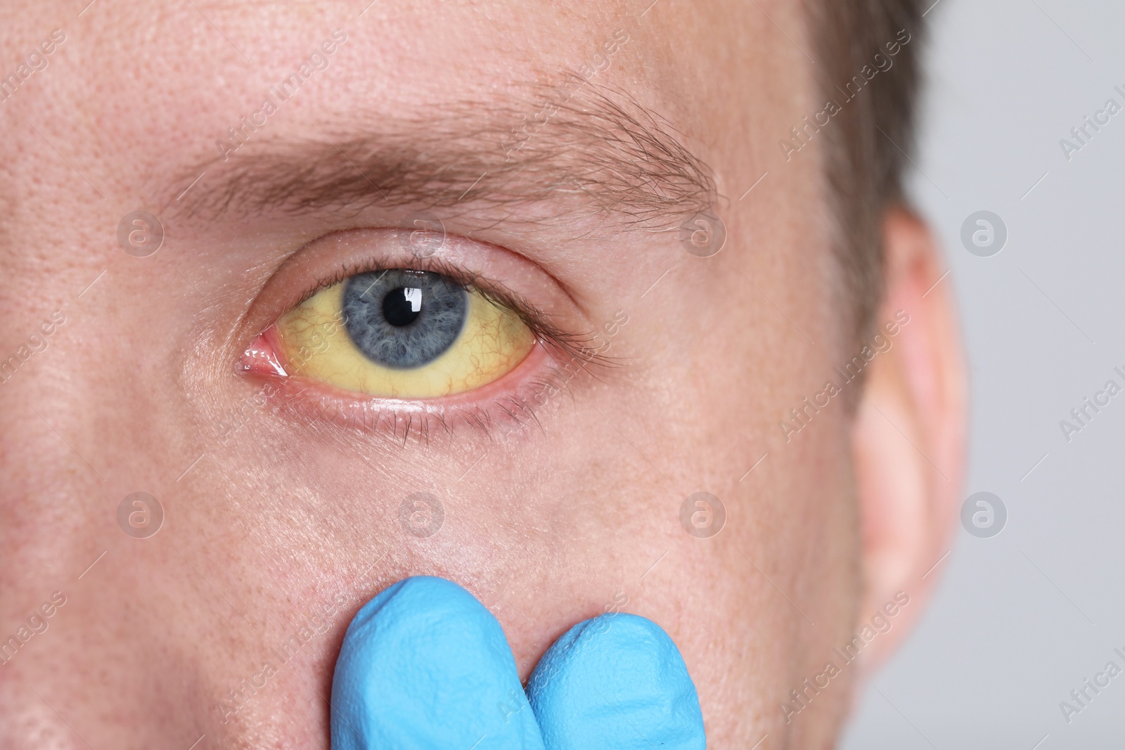 Photo of Doctor checking man with yellow eyes on light background, closeup. Symptom of hepatitis