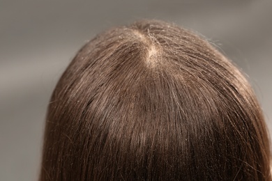 Photo of Woman with dandruff in her dark hair on grey background, closeup