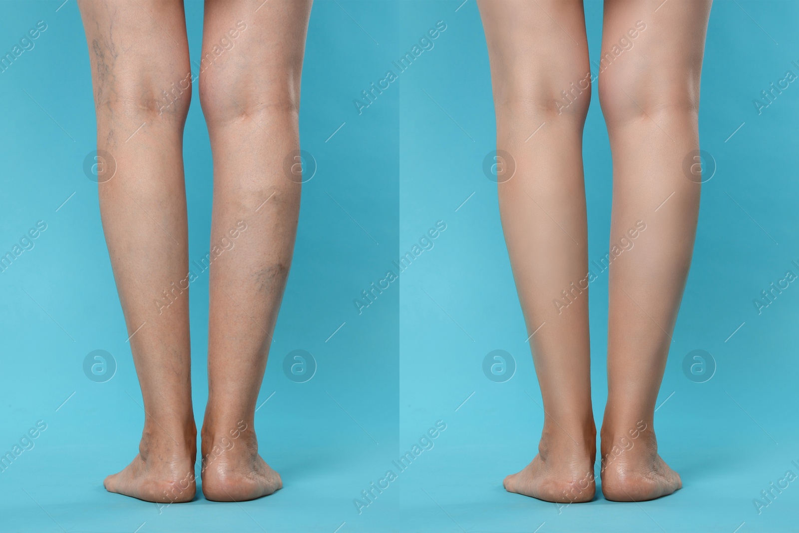 Image of Before and after varicose veins treatment. Collage with photos of woman showing legs on light blue background, closeup