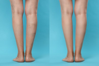 Image of Before and after varicose veins treatment. Collage with photos of woman showing legs on light blue background, closeup