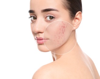 Woman with acne on her face on white background. Zoomed area showing problem skin