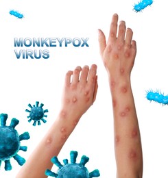 Image of Woman with rash suffering from monkeypox virus on white background, closeup