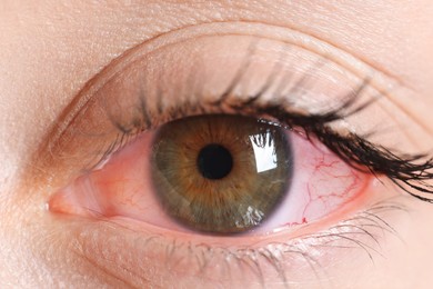 Image of Woman with red eye suffering from conjunctivitis, closeup