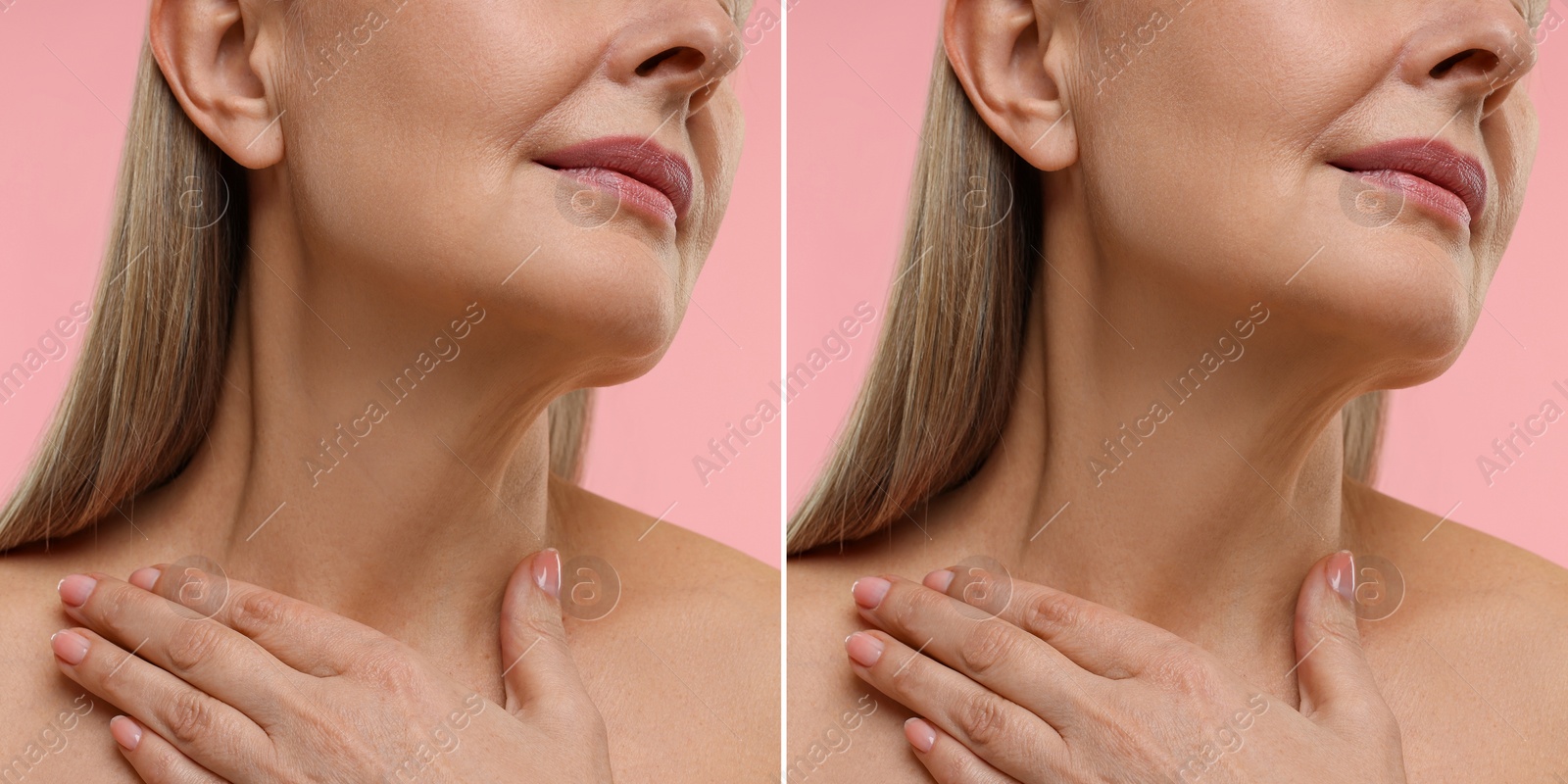 Image of Collage with photos of woman before and after cosmetic procedure on pink background, closeup
