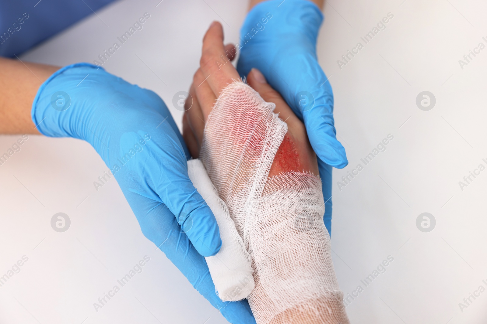 Photo of Doctor bandaging patient's burned hand at table, closeup