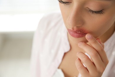 Photo of Woman with herpes touching lips against blurred background, closeup