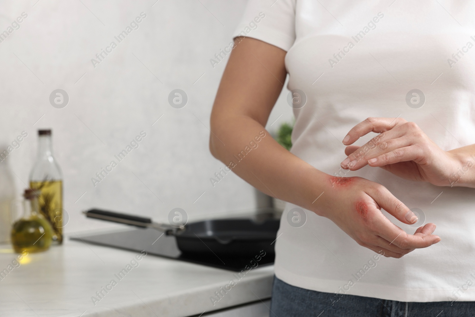 Photo of Woman with burns on her hand in kitchen, closeup. Space for text