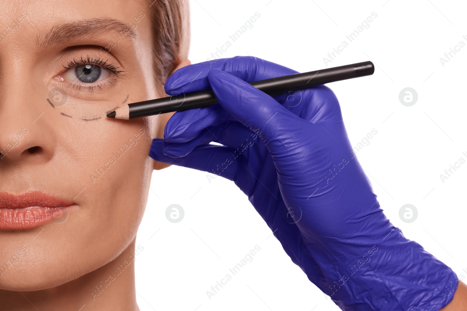 Photo of Doctor with pencil preparing patient for cosmetic surgery operation on white background, closeup