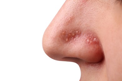 Photo of Young woman with acne problem on grey background, closeup