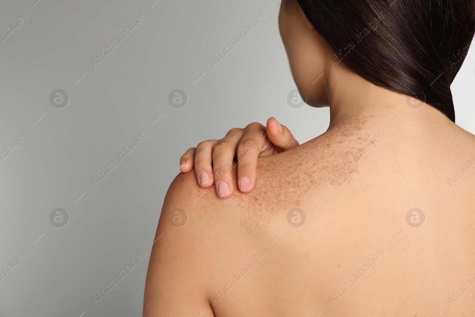 Photo of Closeup of woman`s body with birthmarks on light grey background, back view. Space for text