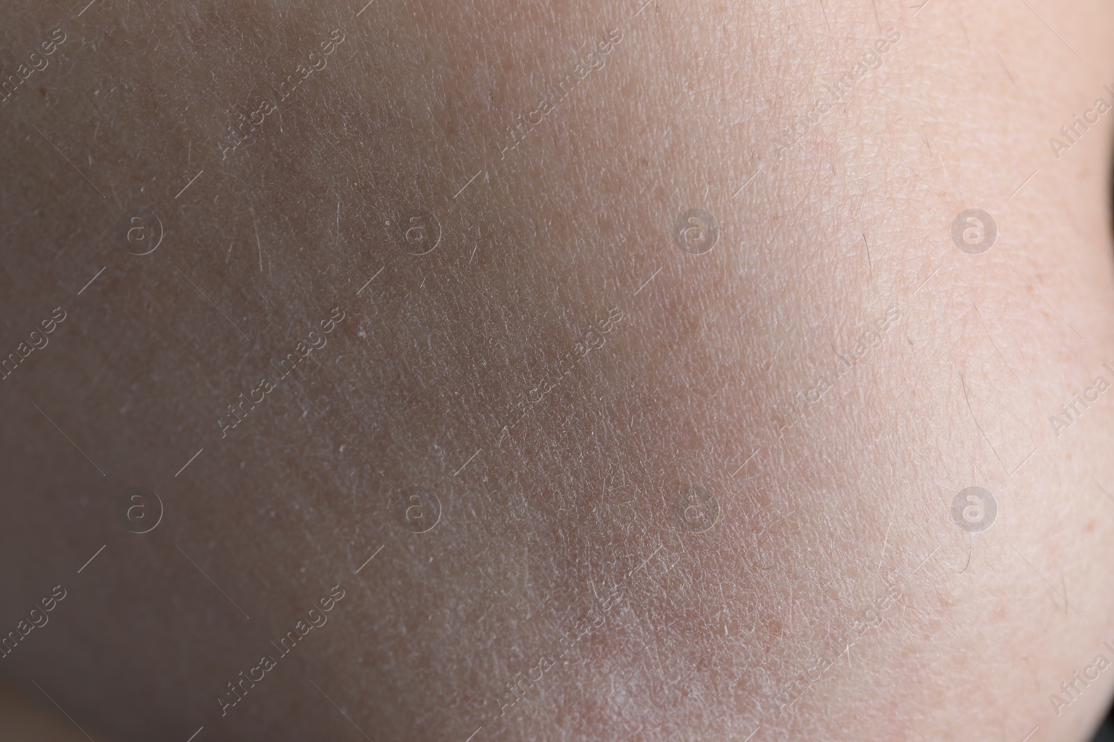 Photo of Closeup view of woman with dry skin