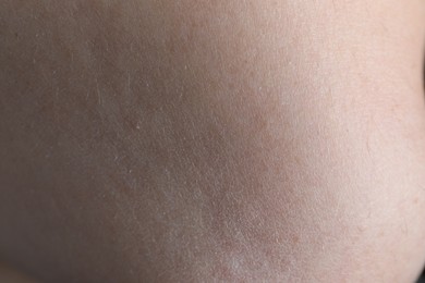 Closeup view of woman with dry skin