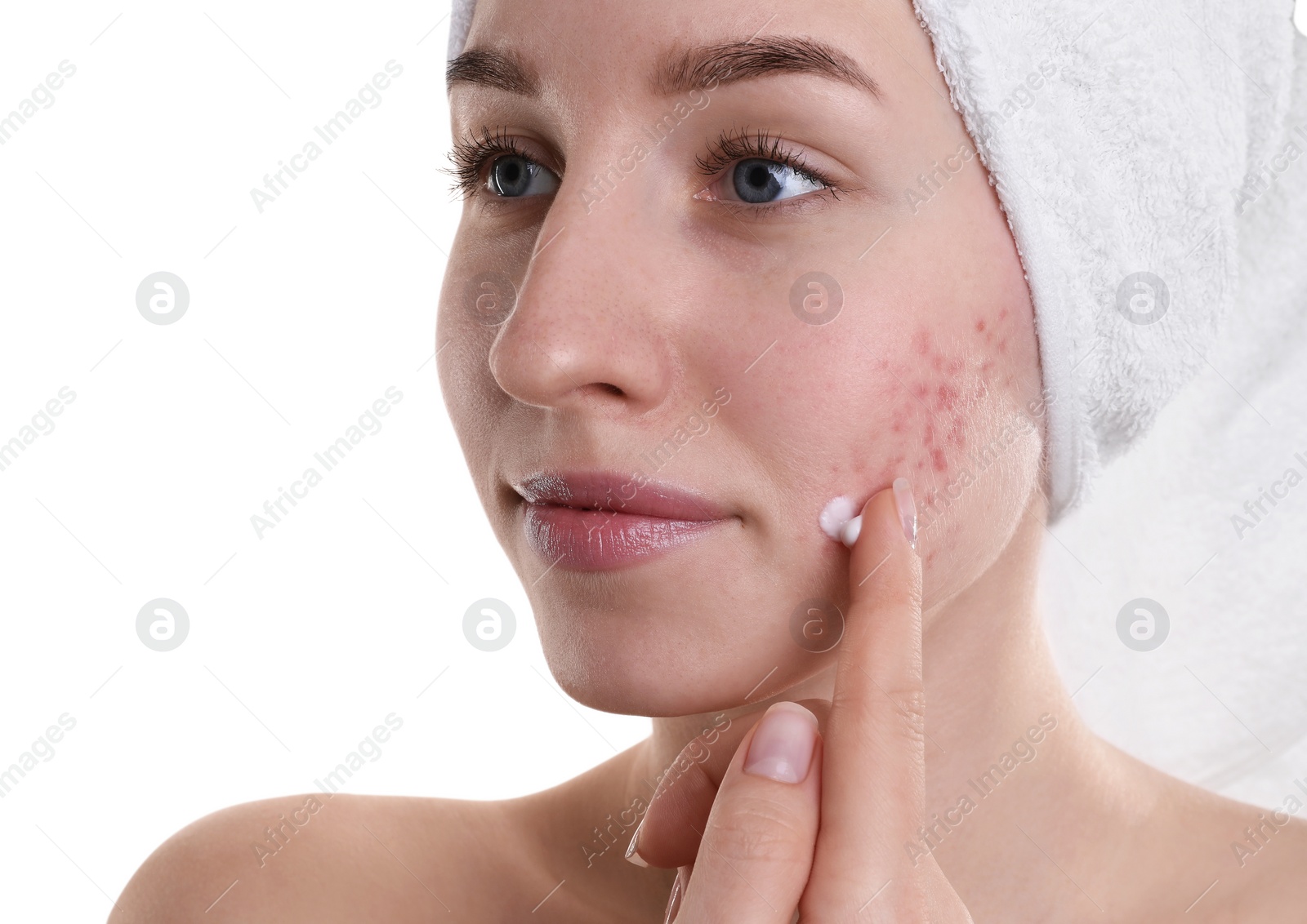 Photo of Young woman with acne problem applying cosmetic product onto her skin on white background, closeup