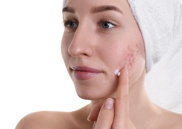 Young woman with acne problem applying cosmetic product onto her skin on white background, closeup