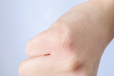 Photo of Woman with dry skin on hand against light background, closeup