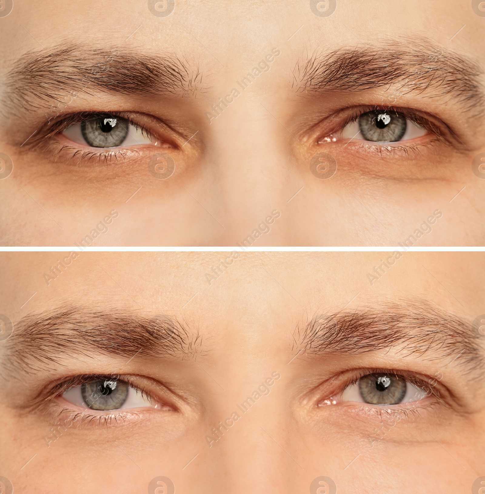 Image of Collage with photos of tired man with dark circle under eye and after rest, closeup