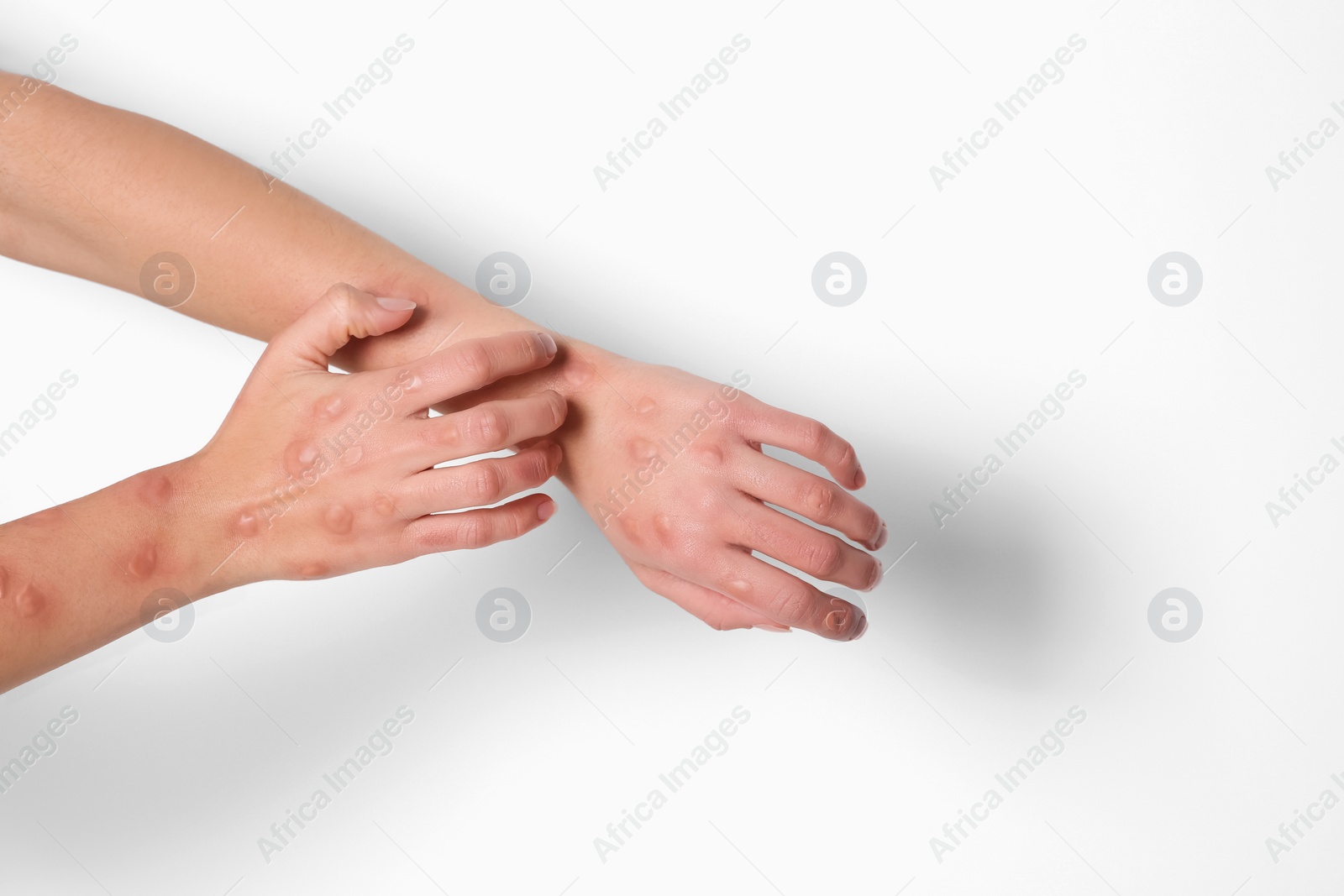 Photo of Woman with rash suffering from monkeypox virus on white background, closeup. Space for text