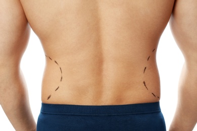 Photo of Young man with marks on body for cosmetic surgery operation against white background, closeup