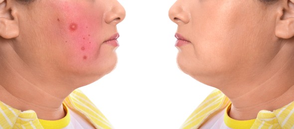 Image of Before and after rosacea treatment. Photos of woman on white background, closeup. Collage showing affected and healthy skin