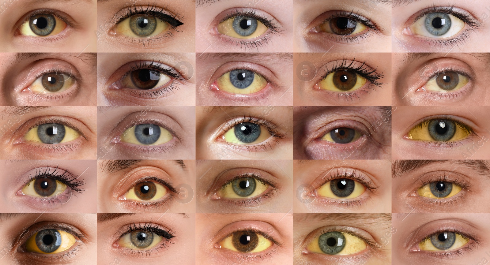 Image of Yellowing of eyes as symptom of hepatitis. Collage with photos of people