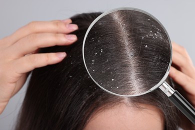 Image of Woman suffering from dandruff on light grey background, closeup. View through magnifying glass on hair with flakes