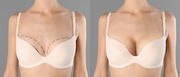 Image of Collage with photos of young woman before and after breast size correction on grey background, closeup. Banner design