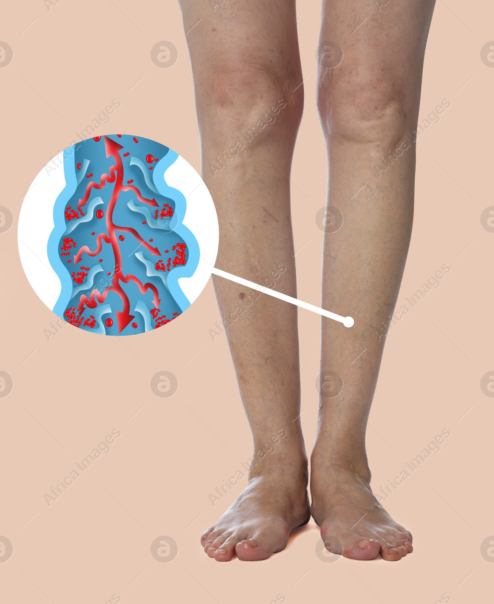 Image of Closeup view of woman with varicose veins on beige background. Illustration of damaged vein, longitudinal section