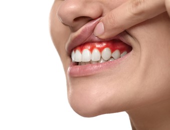 Image of Woman showing inflamed gum on white background, closeup