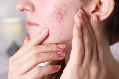 Photo of Woman with acne problem at home, closeup