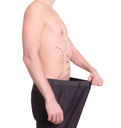 Young man with marks on belly for cosmetic surgery operation on white background