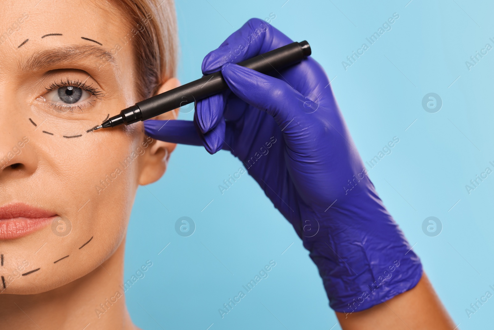 Photo of Doctor with marker preparing patient for cosmetic surgery operation on light blue background, closeup