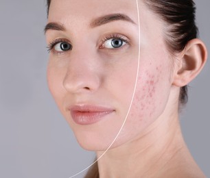 Acne problem, collage. Woman before and after treatment on grey background