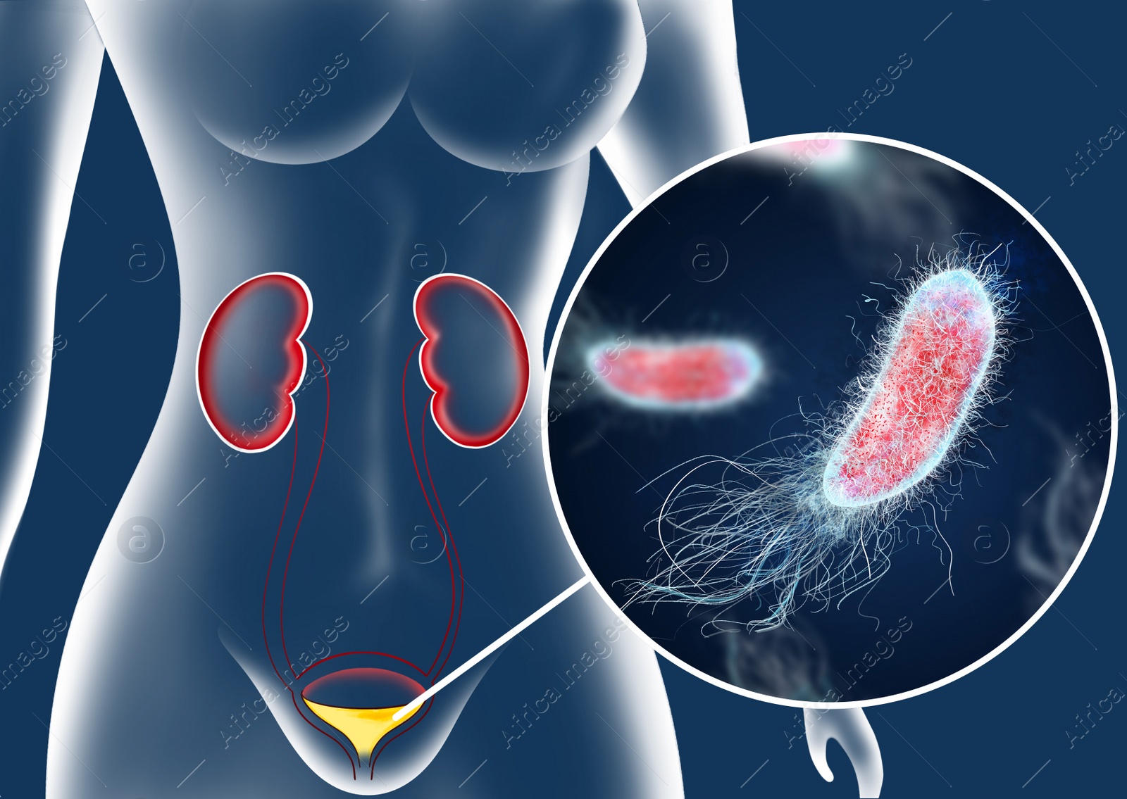 Illustration of  woman suffering from cystitis. Urinary infection