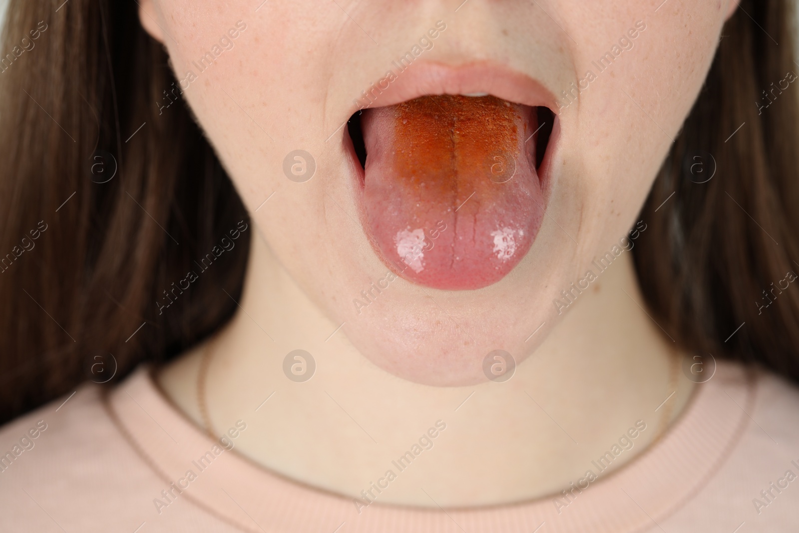 Photo of Gastrointestinal diseases. Woman showing her yellow tongue, closeup