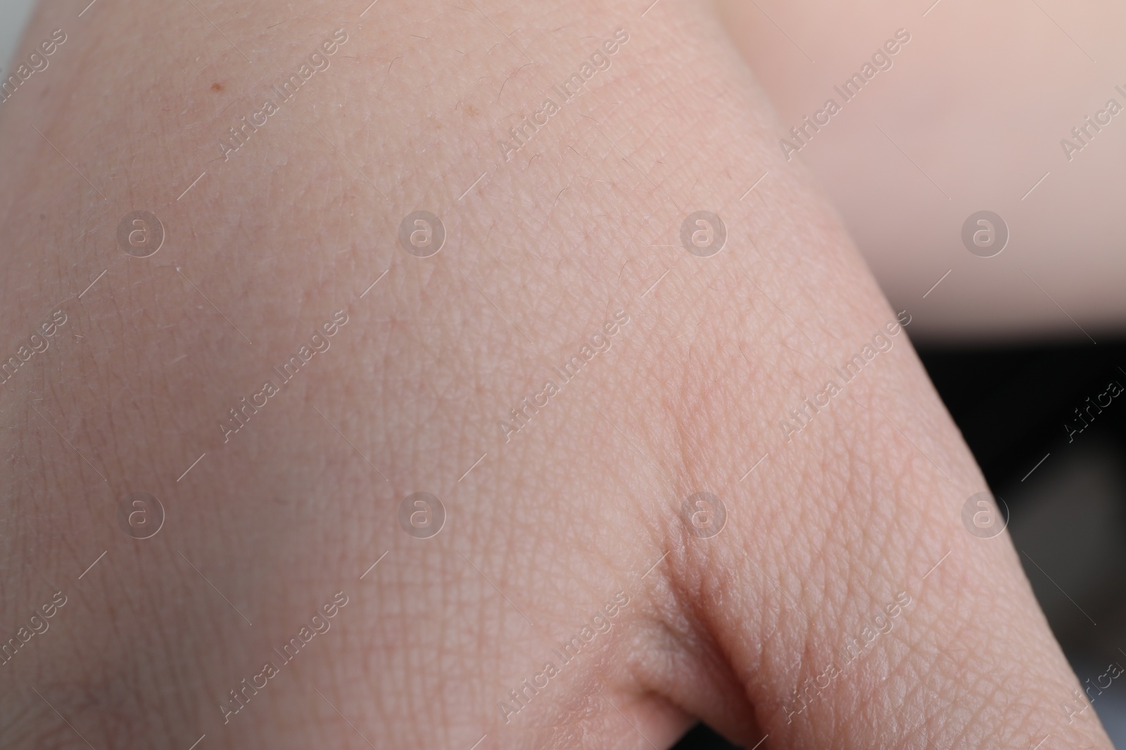 Photo of Woman with dry skin on hand, closeup