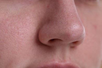 Photo of Closeup view of woman with blackheads on her nose