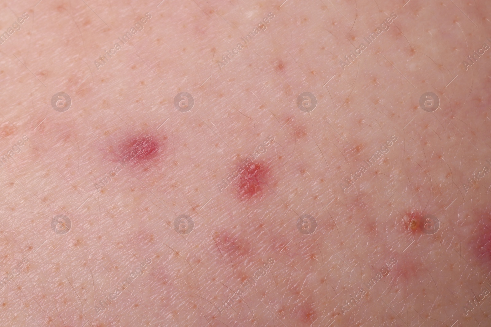 Photo of Young person with acne problem, closeup view of skin