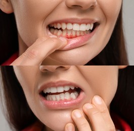 Image of Woman showing gum before and after treatment, collage of photos