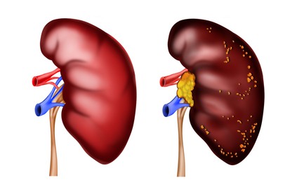Illustration of  healthy and diseased kidneys on white background